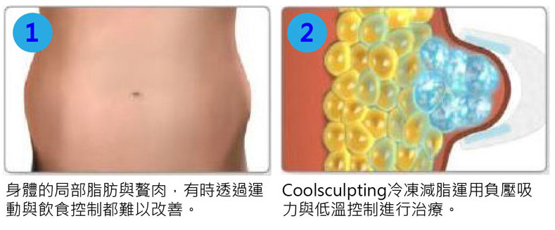 酷塑冷凍溶脂儀器：庫爾塑平Coolsculpting