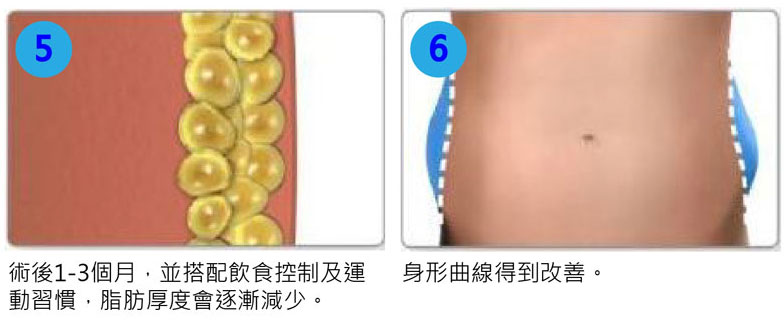 酷塑冷凍溶脂儀器：庫爾塑平Coolsculpting