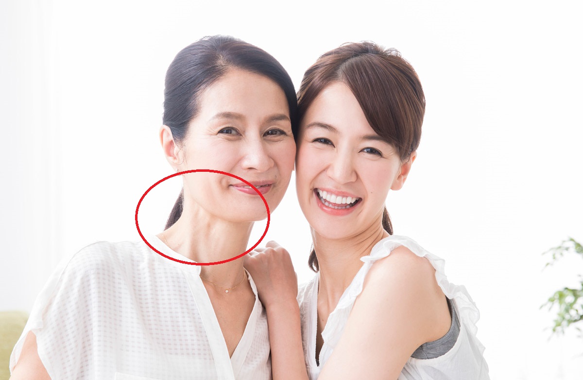 肉毒桿菌素拉提