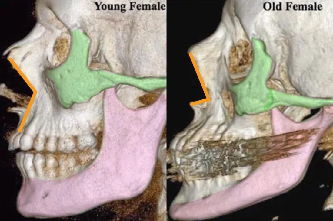 年輕人與熟齡族群骨骼體積的差異