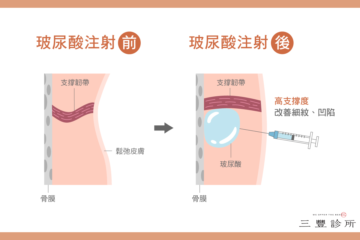 配圖三-唯長膠原蛋白獨尊？