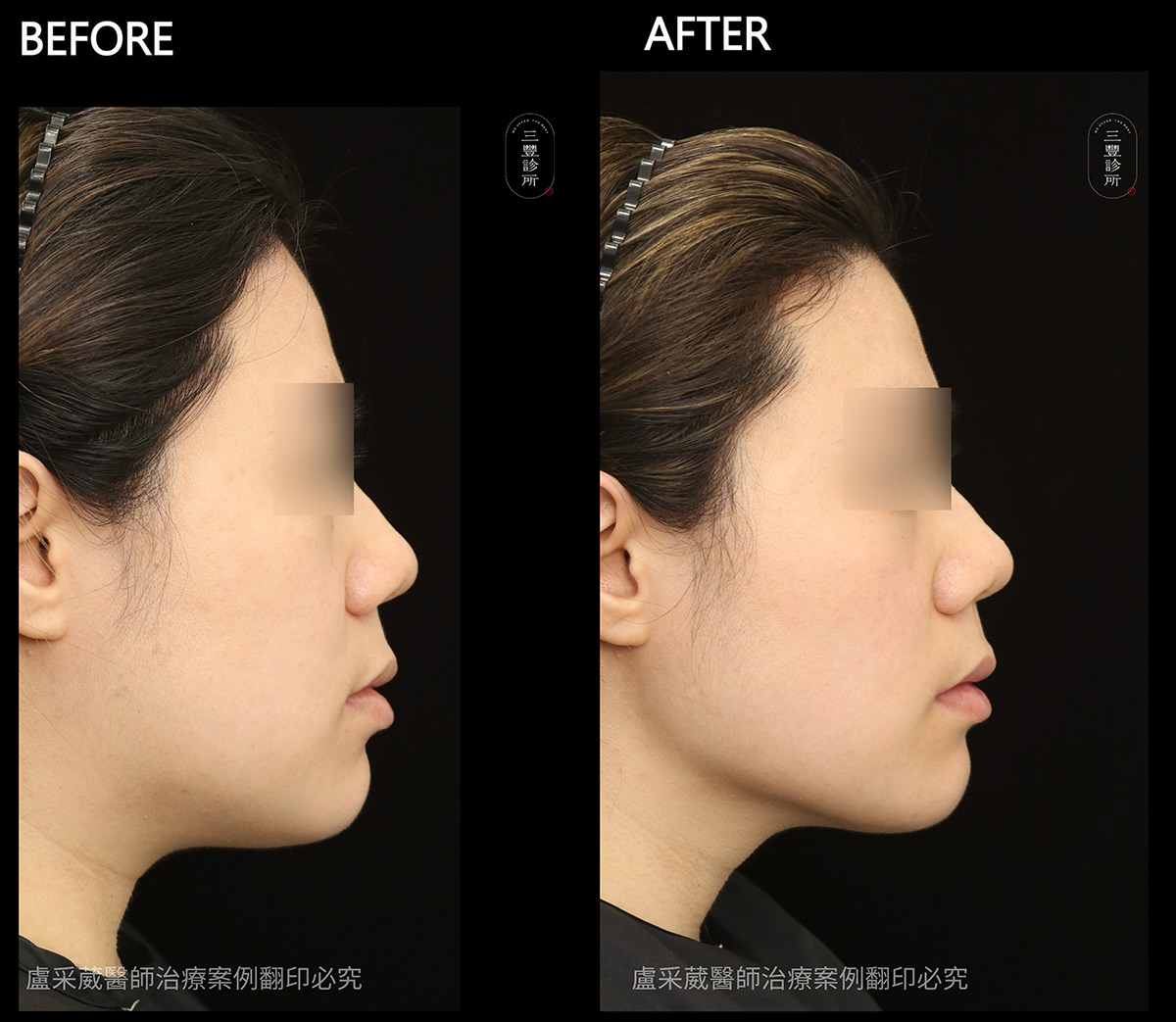台北鳳凰電波案例術前術後比較 - 三豐診所