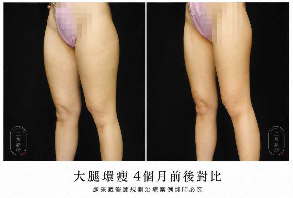 腹部冷凍溶脂推薦案例 腹部冷凍溶脂推薦案例